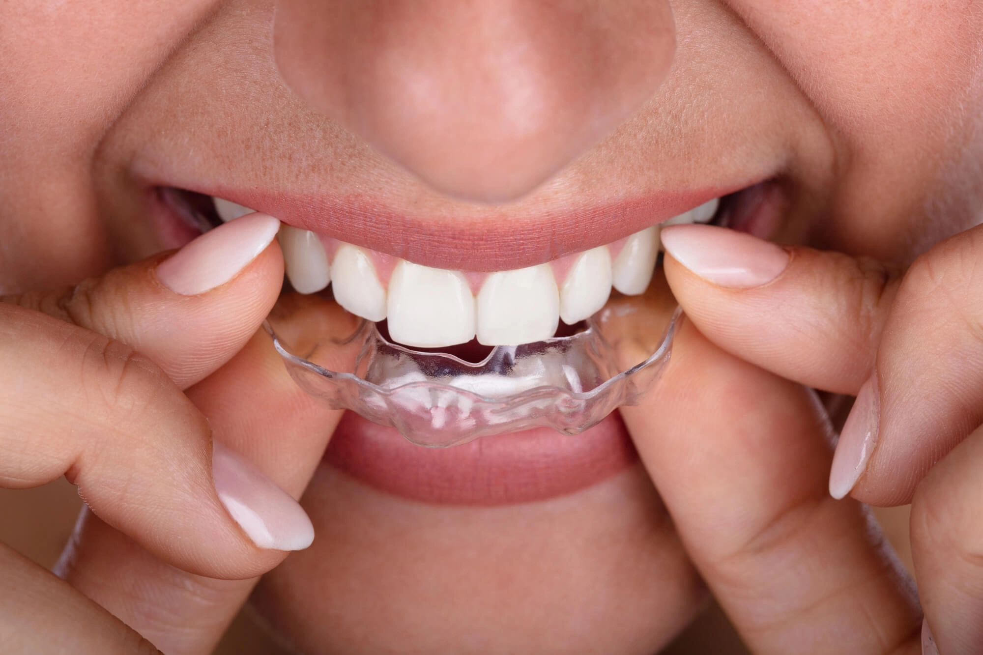 Patient wearing aligners cosmetic dentistry new smyrna beach fl