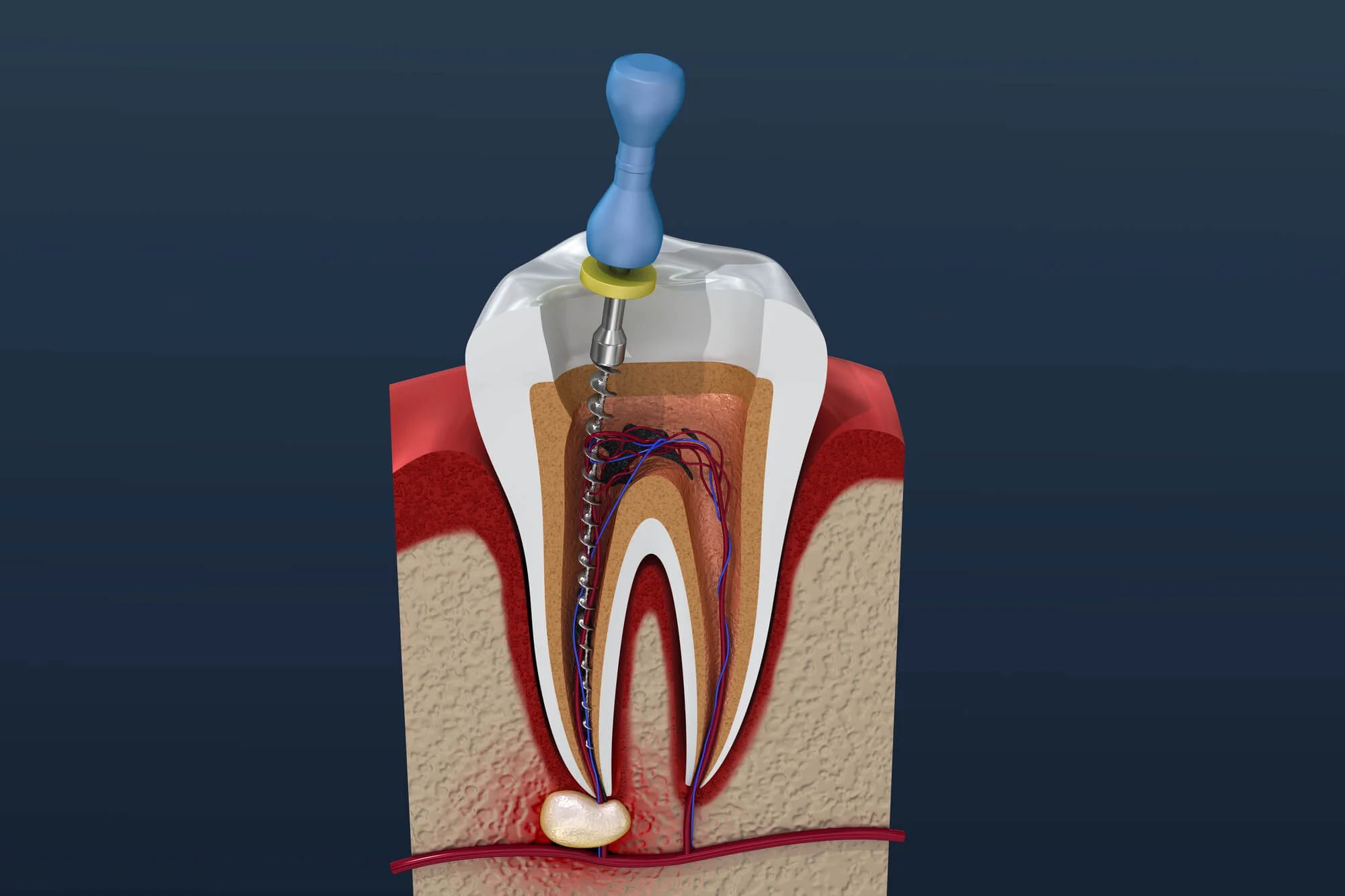 Root canal procedure root canal specialist in New Smyrna Beach FL