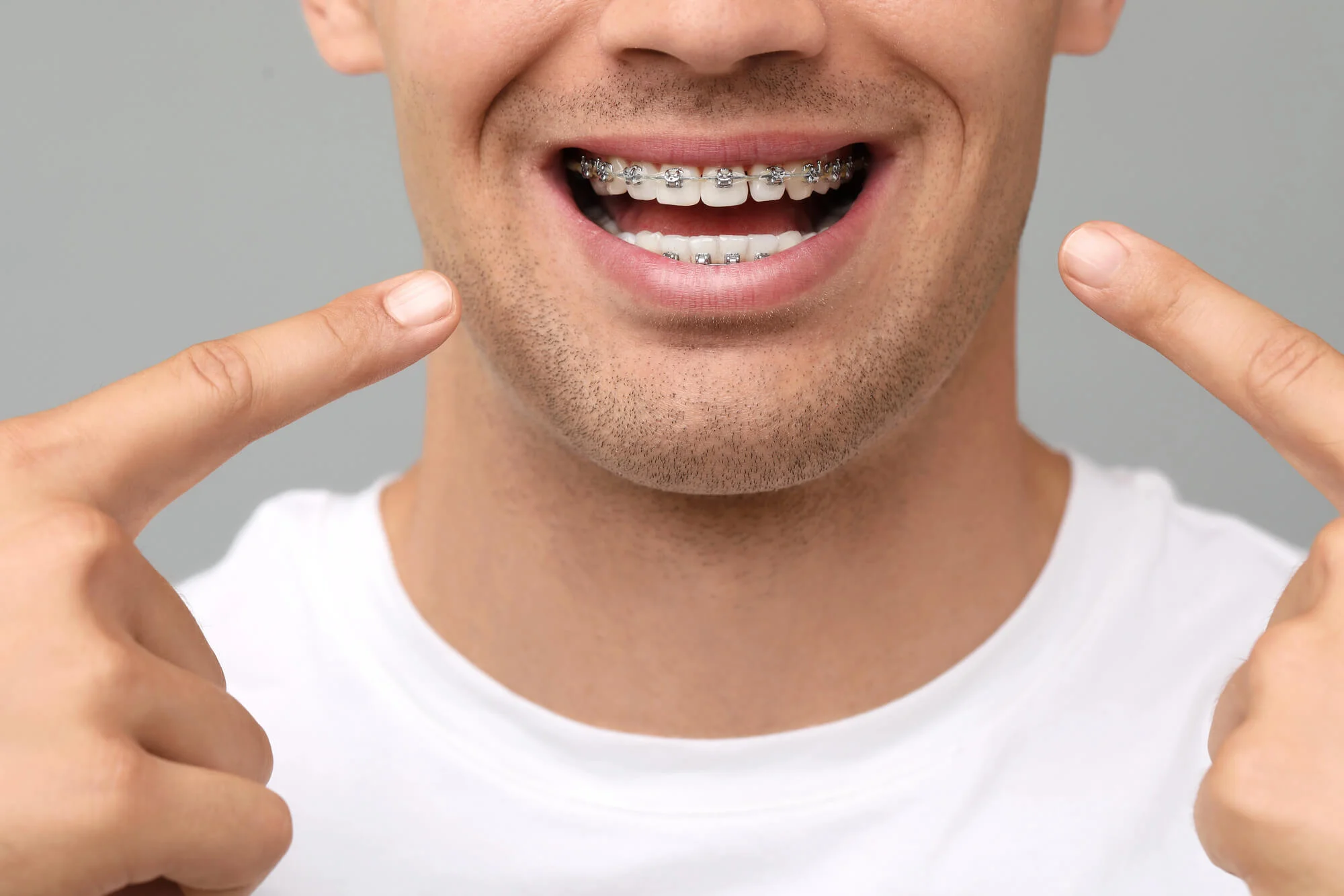 Braces treatment at family dentistry in New Smyrna Beach