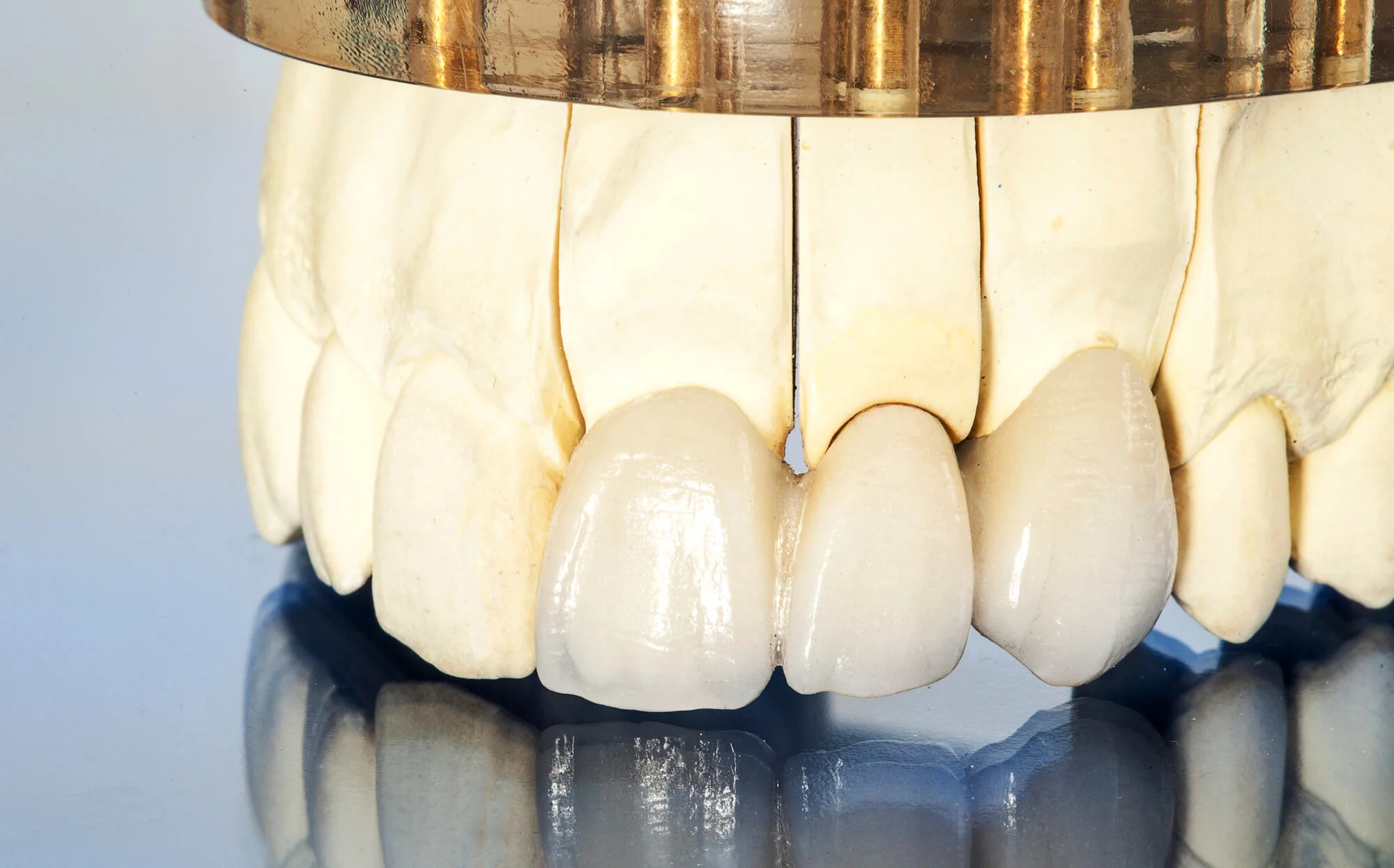 Close-up of implant-supported crown model for dental implants in New Smyrna Beach