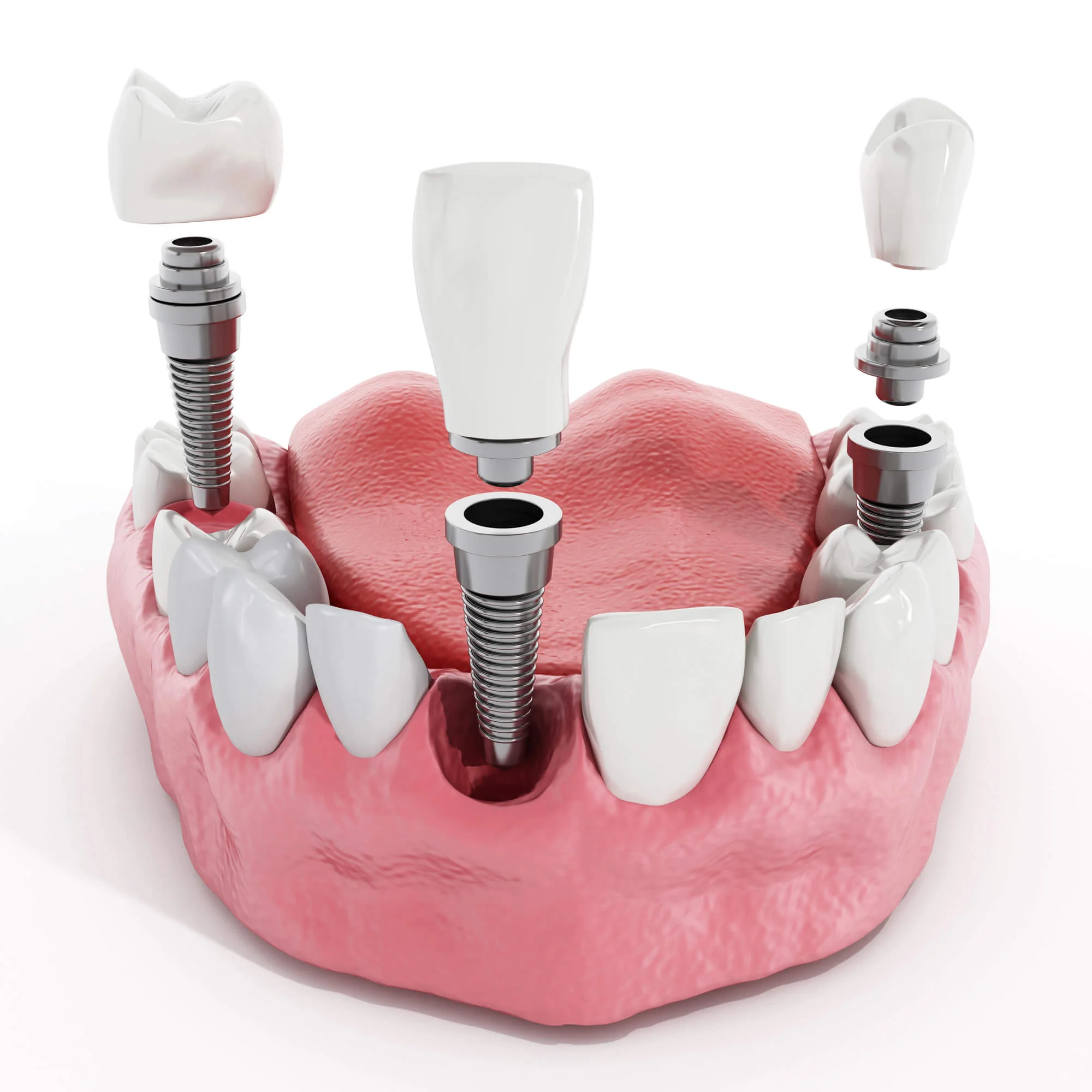 Dental implant components illustration for dental implants in New Smyrna Beach
