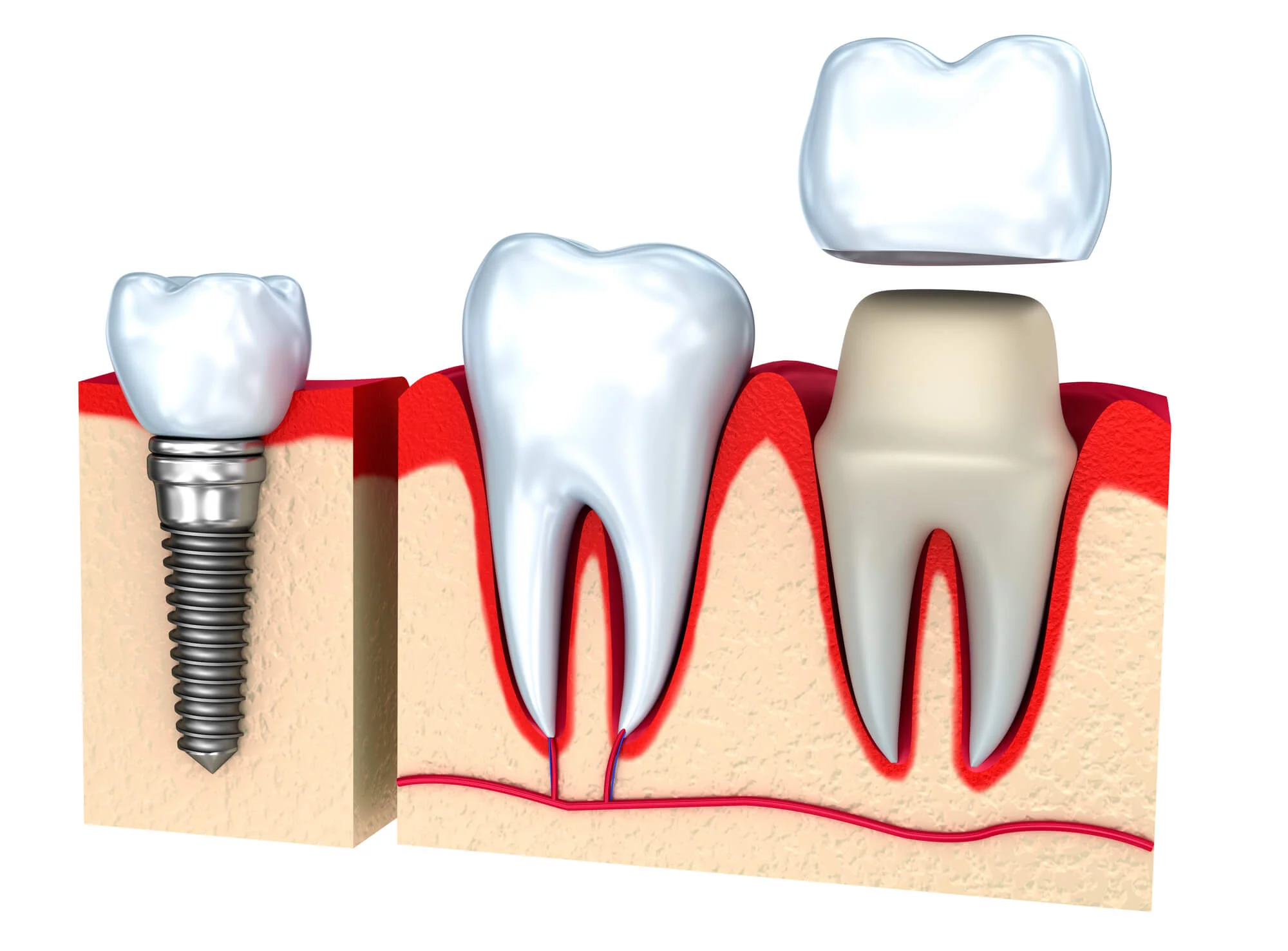 Dental implants in New Smyrna Beach FL compared with a natural tooth.