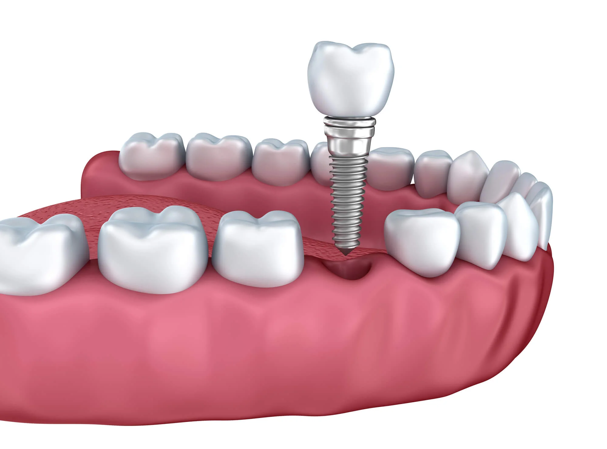 Dental implants in New Smyrna Beach FL restoring a natural smile.