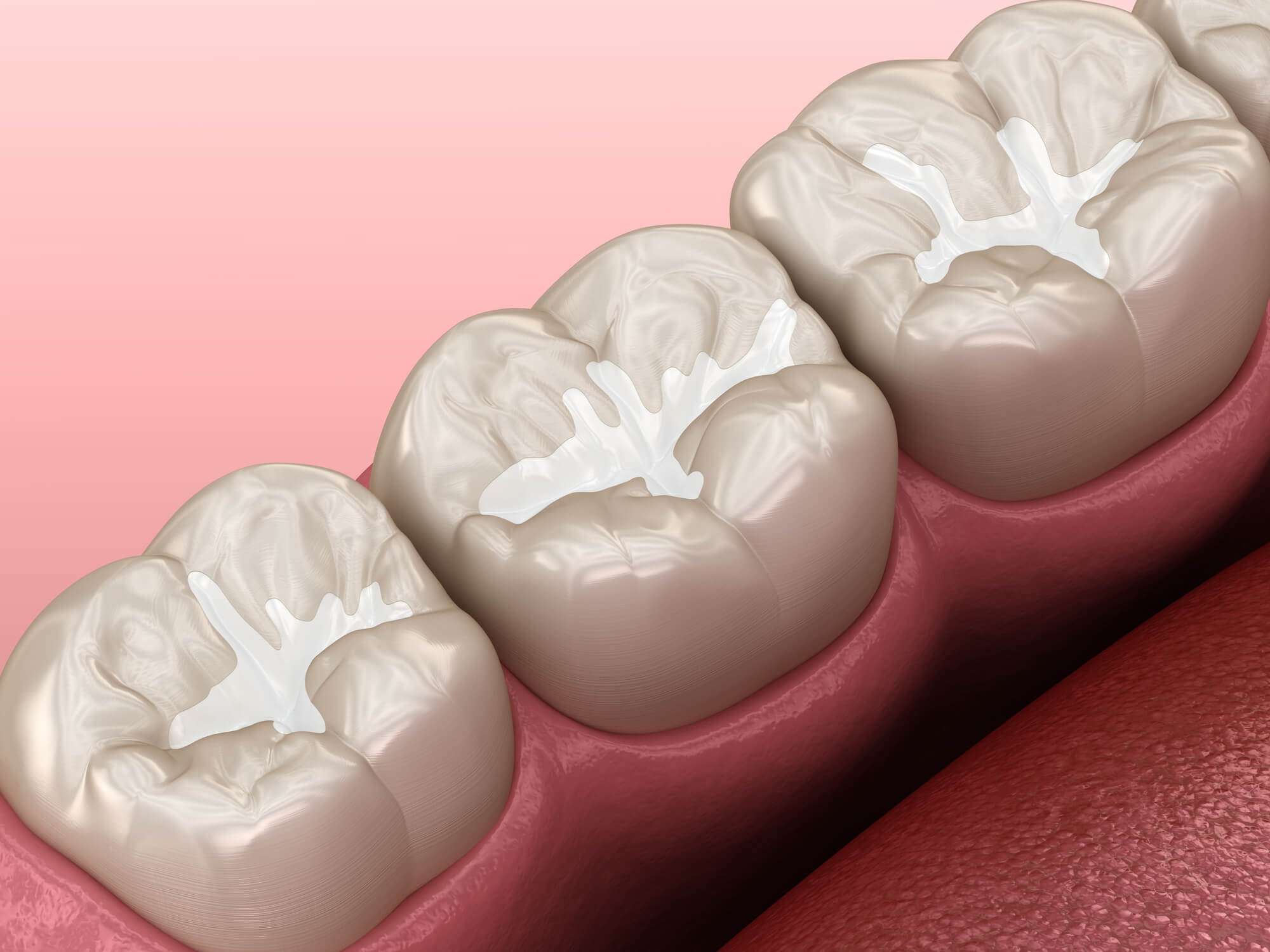 dental sealants image used by pediatric dentists new smyrna beach fl